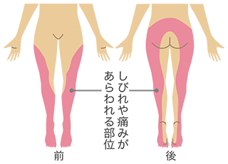 坐骨神経痛のしびれや痛みがあらわれる部位