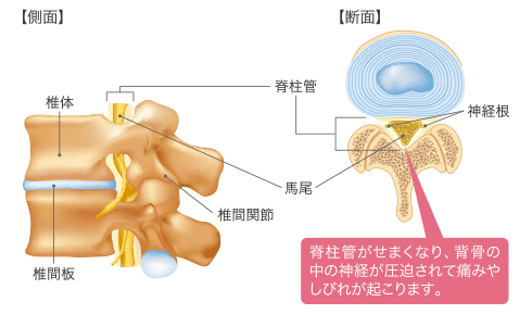 脊柱管狭窄症